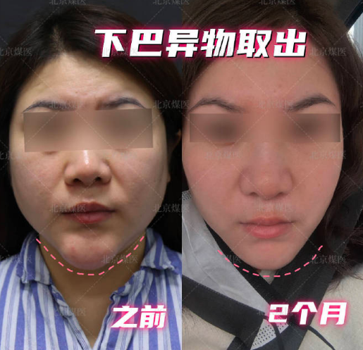北京周云超取異物取出怎么樣？技術好不好？能取干凈嗎？