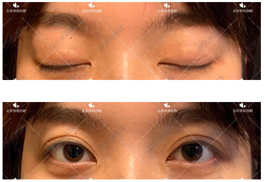 北京協和白明雙眼皮做的怎么樣？