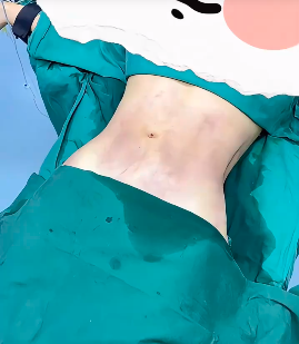 廖偉峰吸脂案例