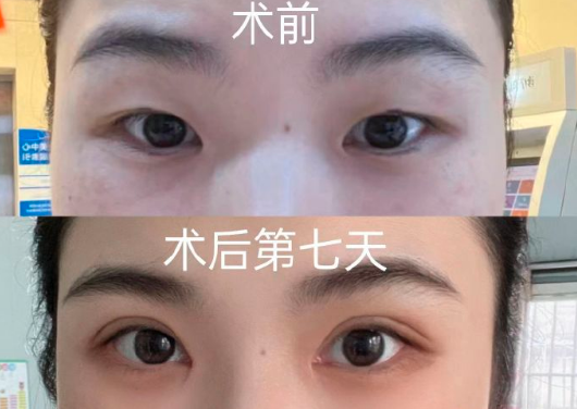 肖潮雙眼皮案例