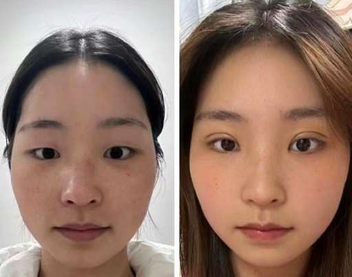 西安肖潮醫生雙眼皮做的怎么樣？