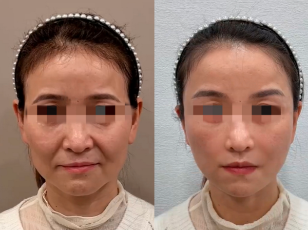 濟南王召東筋膜提升技術(shù)怎么樣？