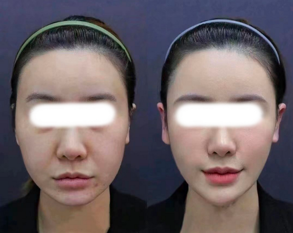 國內擅長做無痕筋膜提升的醫生有哪些?