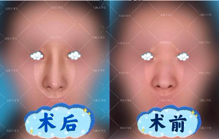 上海九院王守寶做肋骨鼻子怎么樣