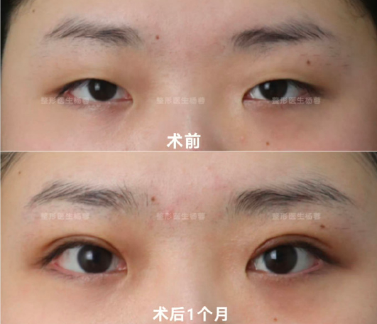 武漢楊蓉做雙眼皮技術怎么樣