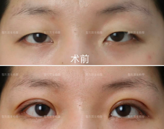 楊蓉雙眼皮案例