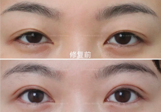 楊蓉雙眼皮修復案例