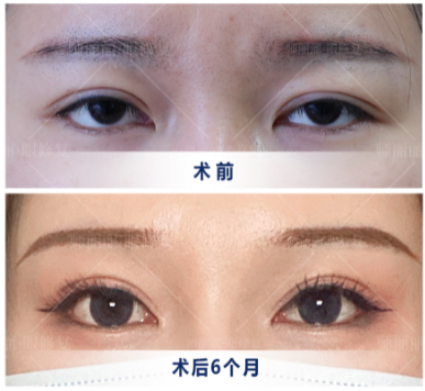 北京雙眼皮修復師麗麗怎么樣