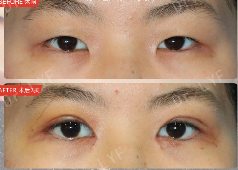 南京劉育鳳做雙眼皮怎么樣？