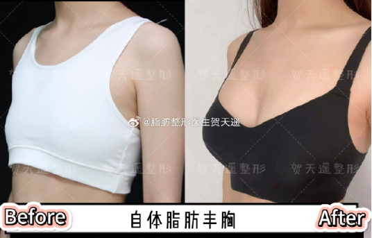 北京賀天遙醫(yī)生做脂肪豐胸技術(shù)怎么樣？
