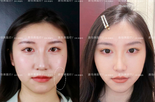 南京李國(guó)偉醫(yī)生做面部吸脂怎么樣？
