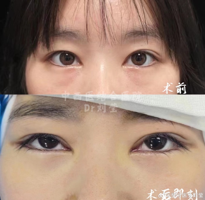 劉瑩去眼袋案例