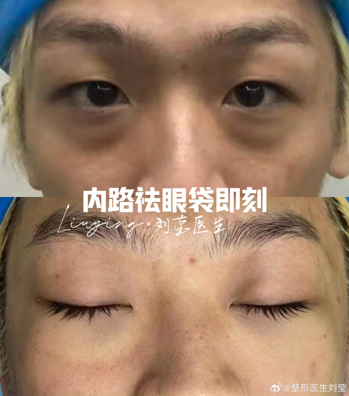 劉瑩醫生祛眼袋案例