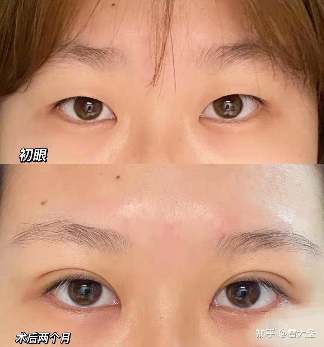 上海九院羅旭松做雙眼皮怎么樣