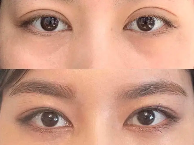 上海九院孫寶珊修復雙眼皮怎么樣
