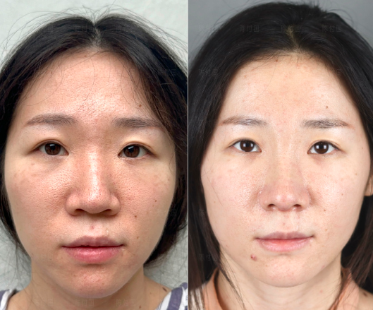 上海九院隆鼻陳付國和魏皎哪個醫生好
