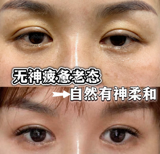 合肥周瑜修復雙眼皮技術怎么樣