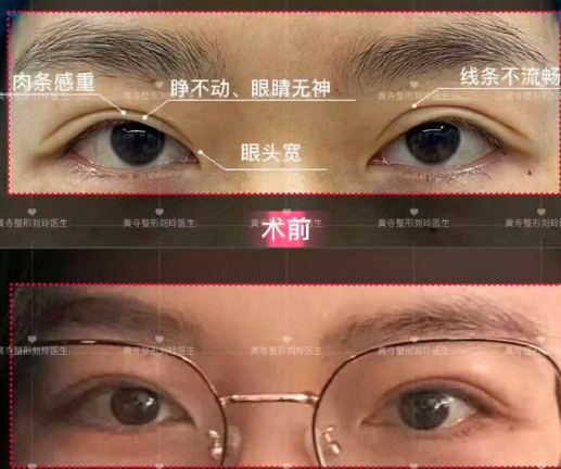 劉玲修復(fù)雙眼皮案例