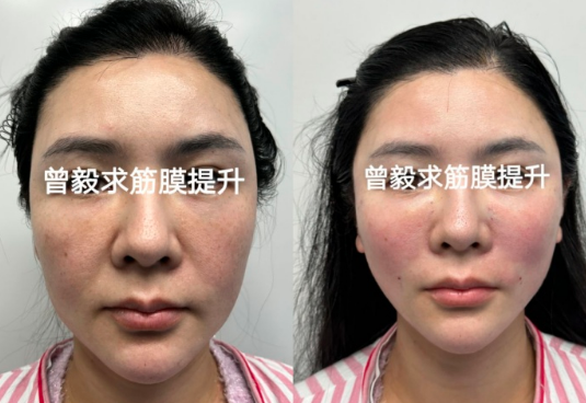 曾毅求醫生