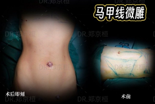 鄭京桓吸脂案例