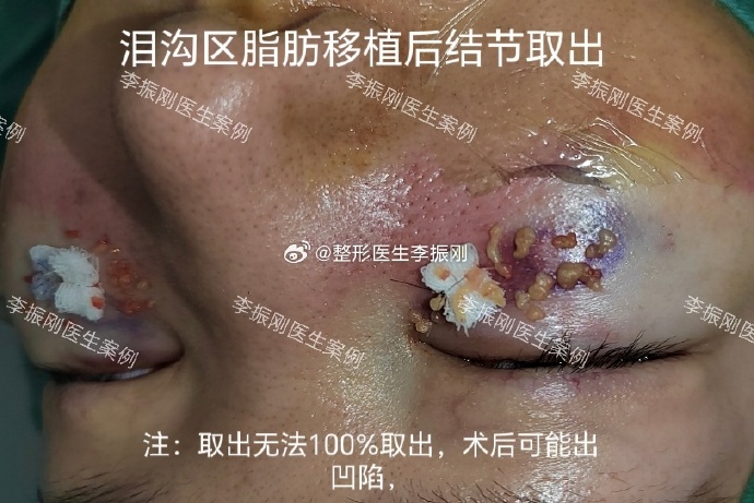 李振剛淚溝脂肪取出案例