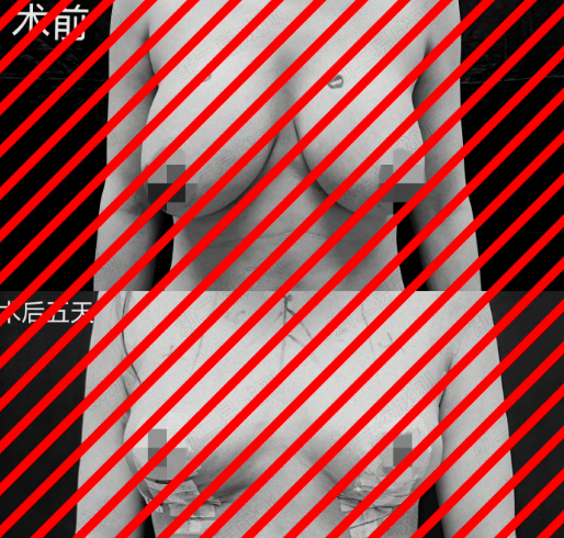 易成剛醫生巨乳縮小案例