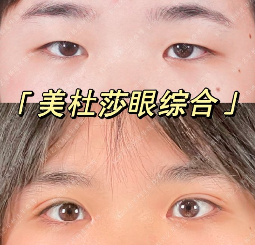楊連華雙眼皮案例