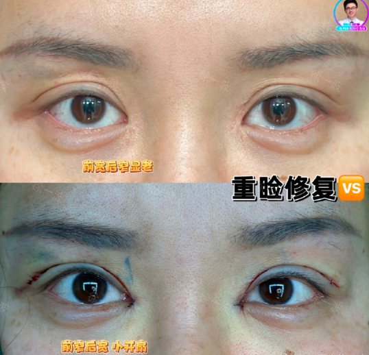 徐一波眼修復案例