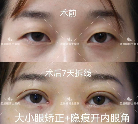 孟晨曦雙眼皮案例
