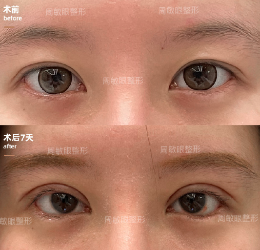 周敏做雙眼皮修復案例