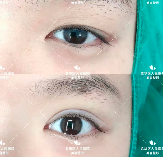 付敏雙眼皮案例