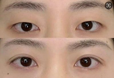 深圳擅長做雙眼皮的醫(yī)生有哪些？