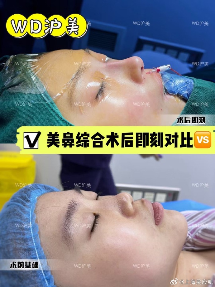 吳應(yīng)凱隆鼻案例