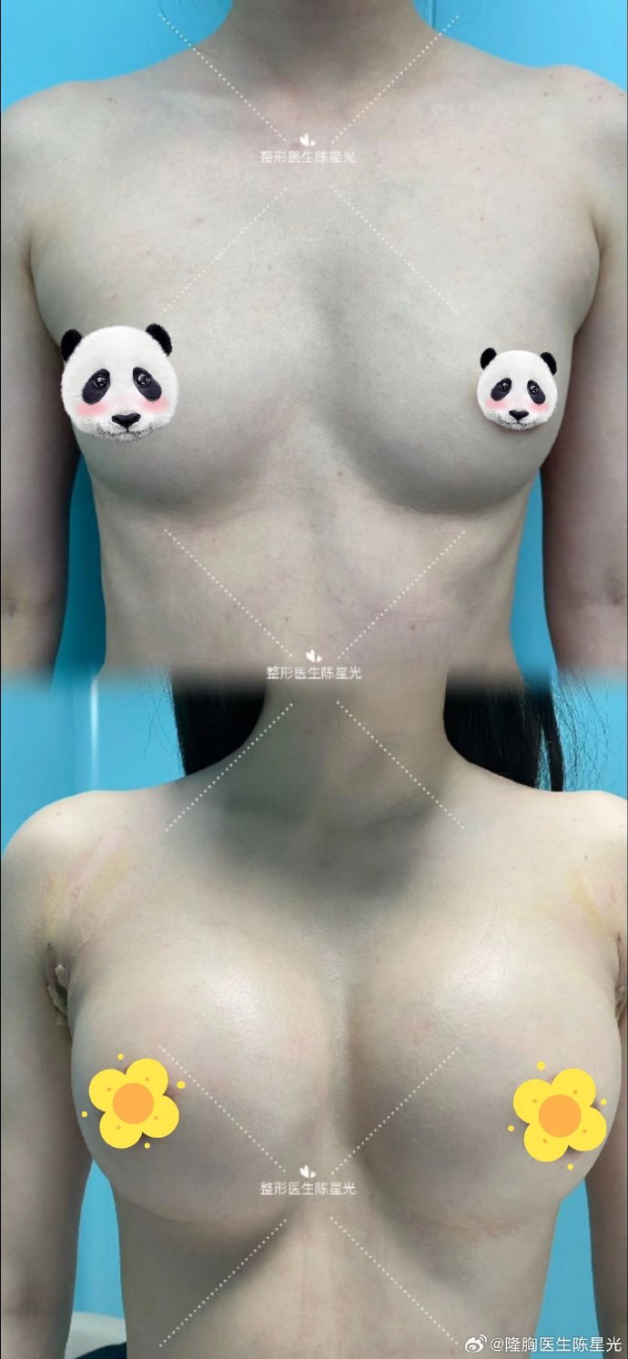 深圳陳星光隆胸技術怎么樣
