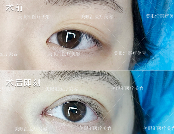 彭青和割雙眼皮案例