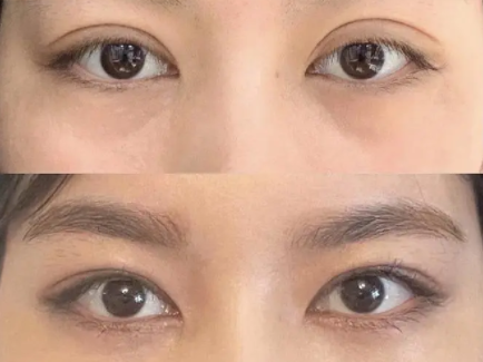 長(zhǎng)沙雙眼皮手術(shù)最好的醫(yī)生是誰?