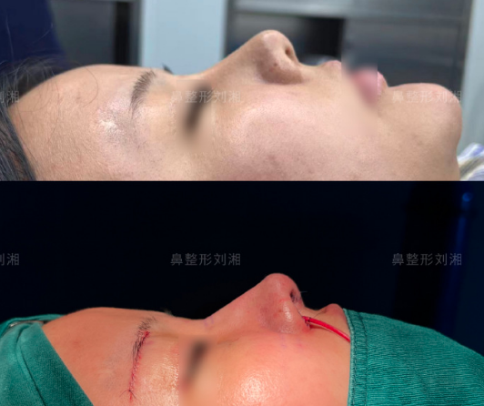 劉湘鼻修復(fù)案例