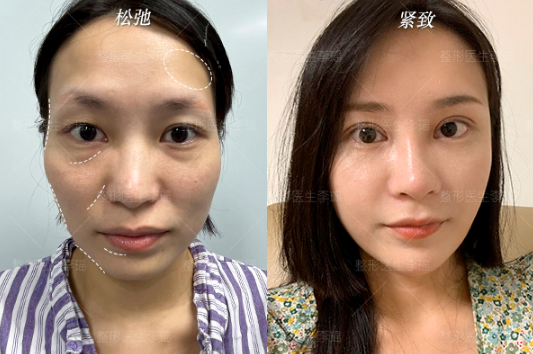 李瑤脂肪填充